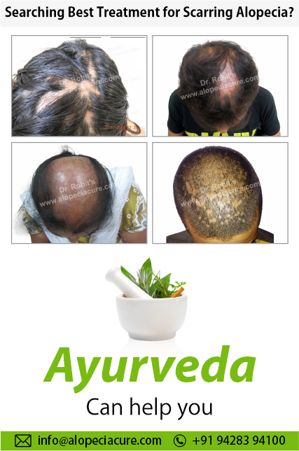 Scarring Alopecia Herbal Topical Therapy
